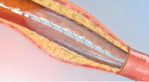 “不留支架，也能保大血管”？DCB治疗大血管冠心病效果首次超越DES！