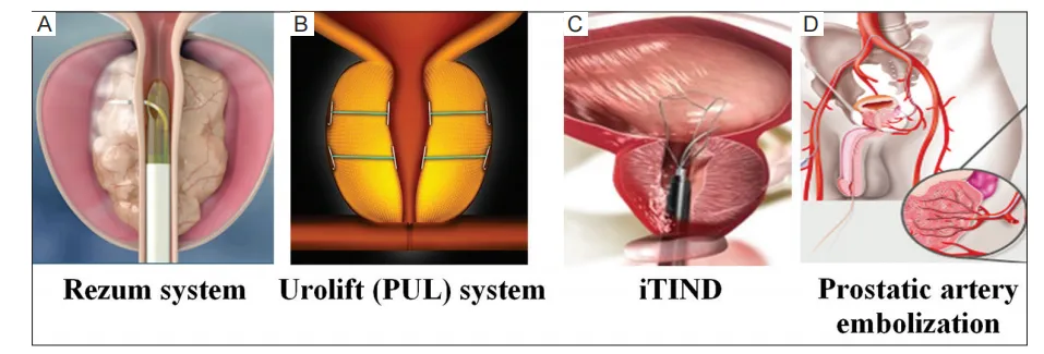 前列腺增生治疗进入微创时代，这4种微创术式或将取代TURP