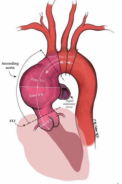 ESVS 2025 升主动脉腔内修复（aTEVAR）标准化指南来了：24条共识，从适应证、支架选择、并发症处理全解析